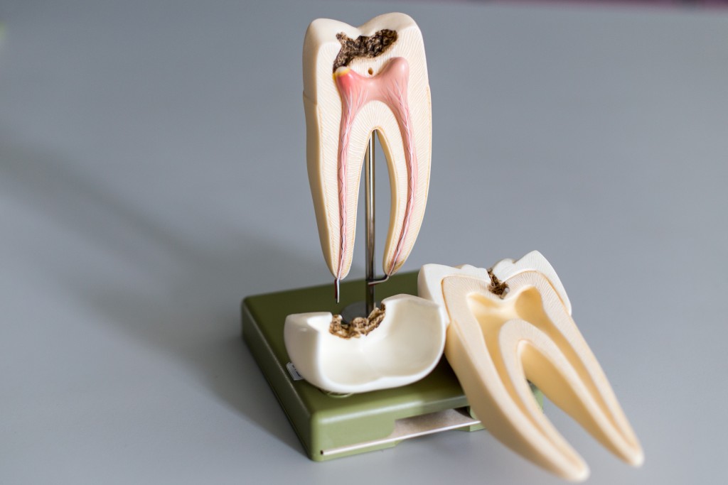 Misconceptions Surrounding Root Canal Treatment