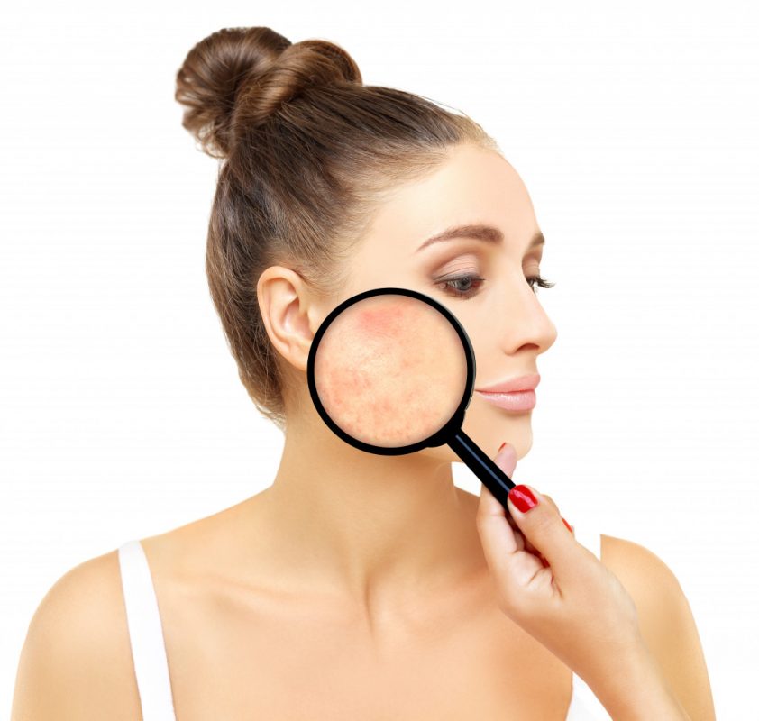 Woman having acne