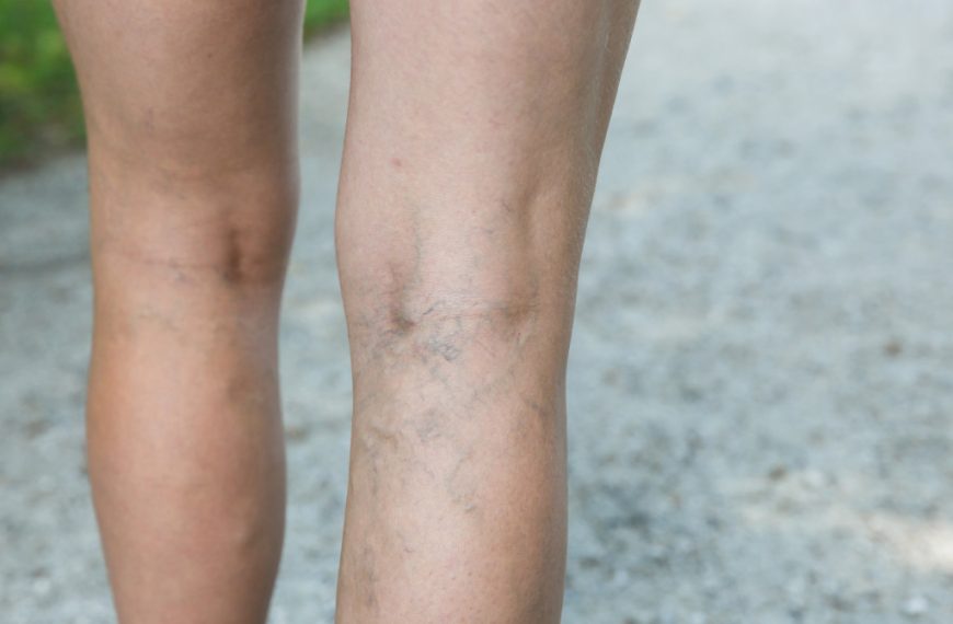 painful varicose veins on woman's legs