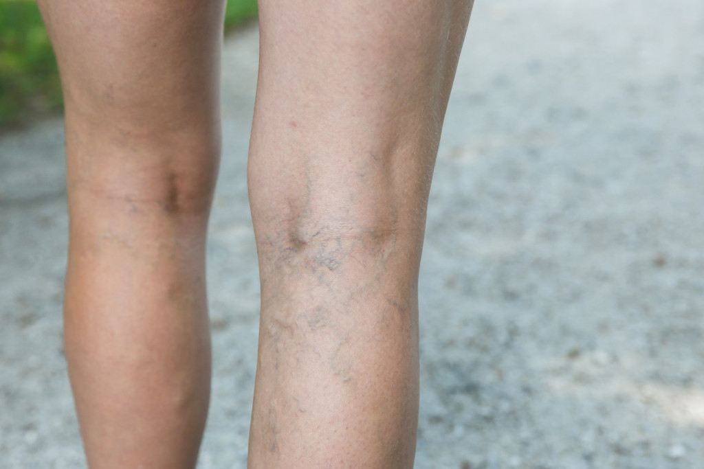 painful varicose veins on woman's legs