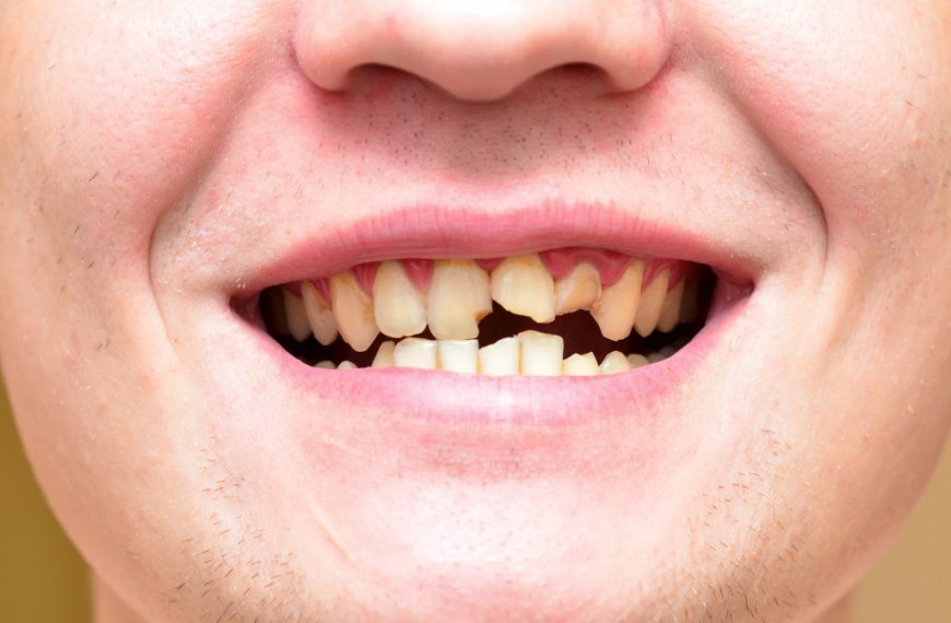 A person with a broken set of teeth